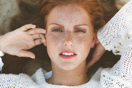 Freckles