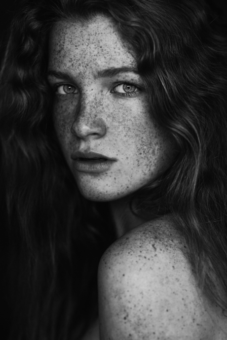 Freckles